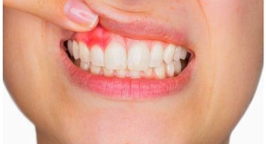 Ramazan Ayında Ağız ve Diş Bakımı Nasıl Yapılmalıdır ?